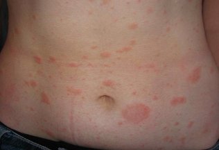 How to treat psoriasis of the organization