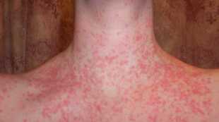 Stages and symptoms of psoriasis