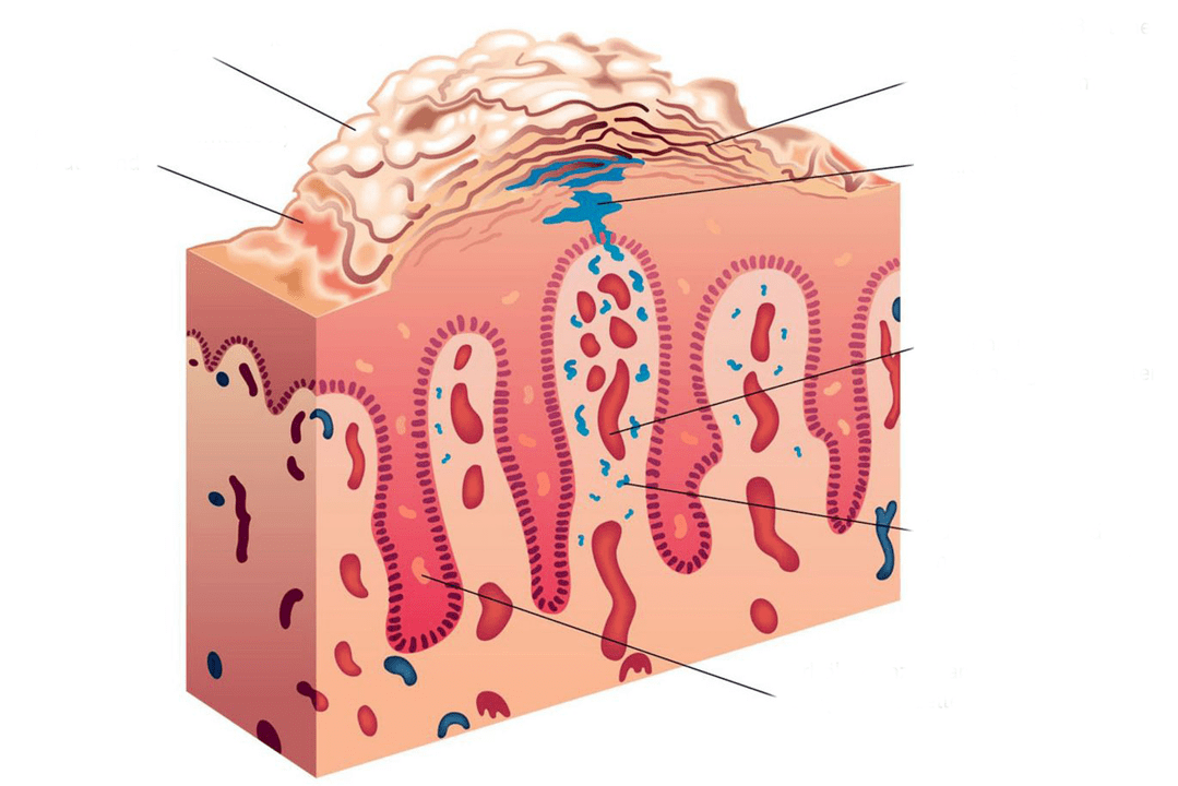 Cross section of skin in psoriasis