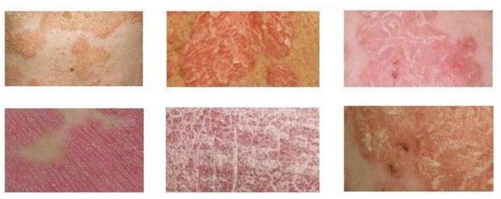 Different types of psoriasis