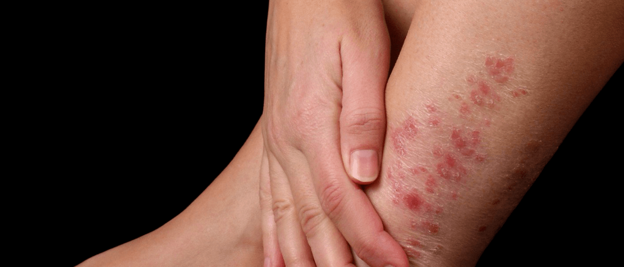 Psoriasis patches on the skin of the feet