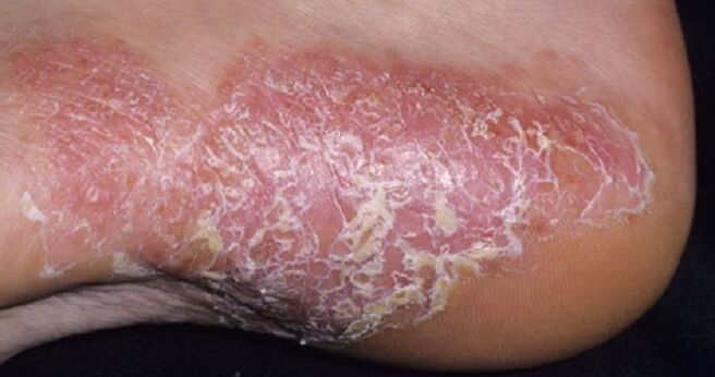 Psoriasis on soles of feet