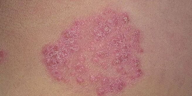 papules on the skin of the feet with psoriasis