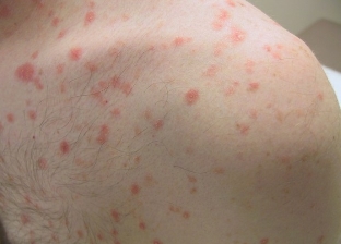 In the initial stages of psoriasis
