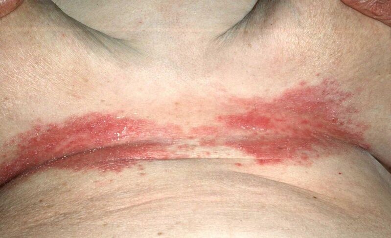 Psoriasis patches under the breast