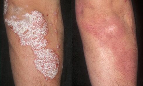 Before and after pictures of psoriasis treatment