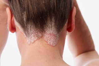 why is there a diaper psoriasis of the scalp