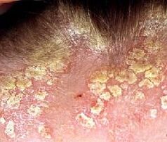 psoriasis on top of photo 1