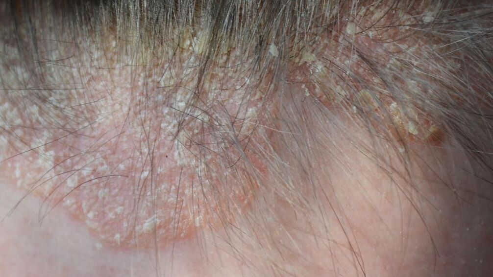 psoriasis on top of photo 4