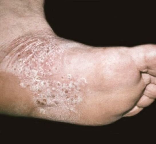 Psoriasis on the feet