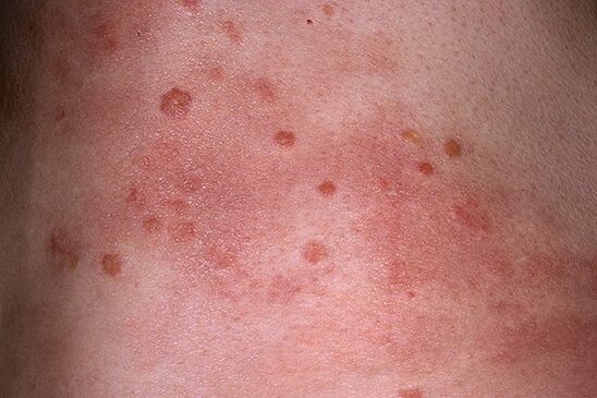 advanced stage of psoriasis