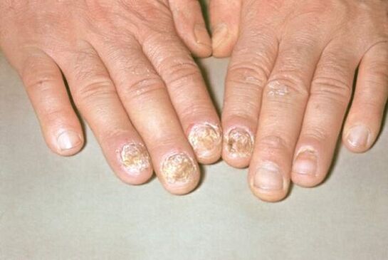 psoriasis nail images 1
