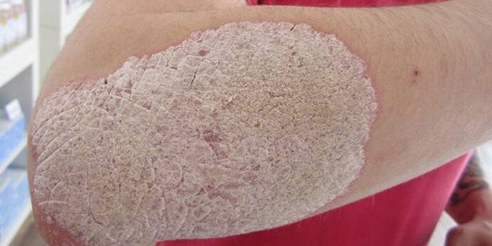 picture of psoriasis on the elbow