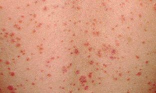 how does the psoriasis initial stage