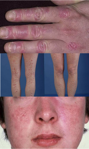 how does the psoriasis of the hands, feet and face