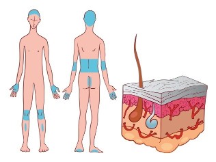 The most common place of occurrence of psoriatic plaques