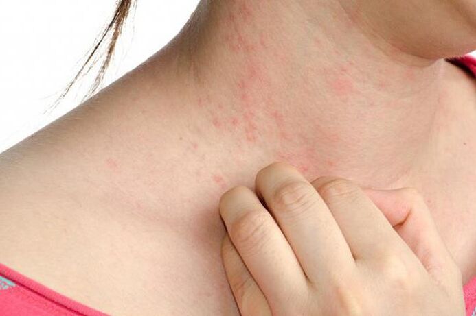 More severe psoriasis presents with skin rashes and severe itching