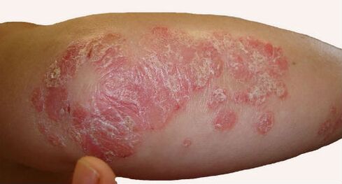 Thick, scaly patches on the elbows when psoriasis is more severe