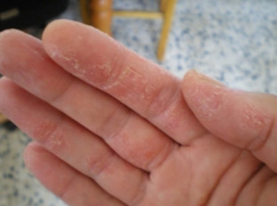 psoriasis of the hands