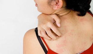 Psoriasis in the back