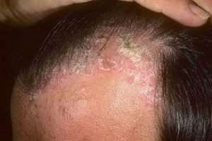 Positive infection on the scalp
