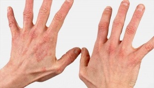 What an early stage of psoriasis looks like