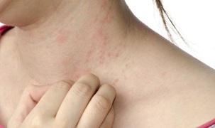 Psoriasis treatment of a severe stage