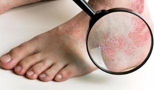 Treatment options of psoriasis