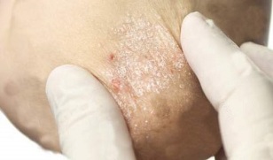 psoriasis treatment during the depletion period