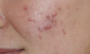 symptoms of early stage psoriasis