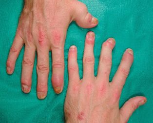 psoriatic arthritis in