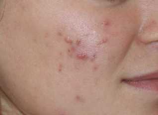 the psoriasis on the face