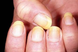 Psoriasis of the nail