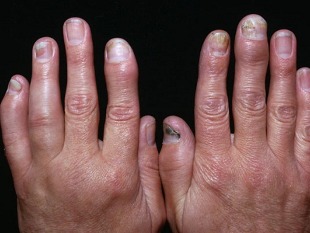 psoriasis, arthritis