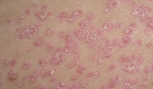In the initial stages of psoriasis