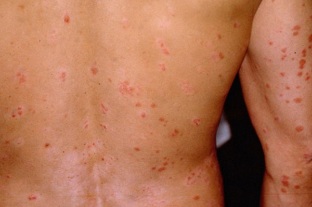 psoriasis initial stages of